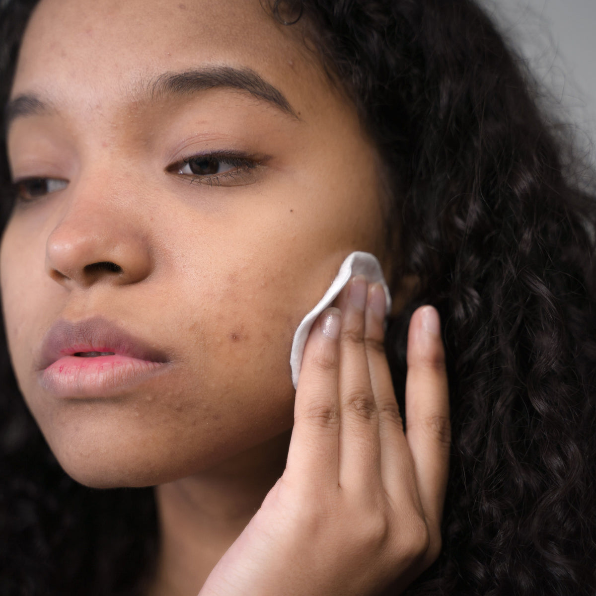 Coming Off the Pill When You Were Put on It for Acne