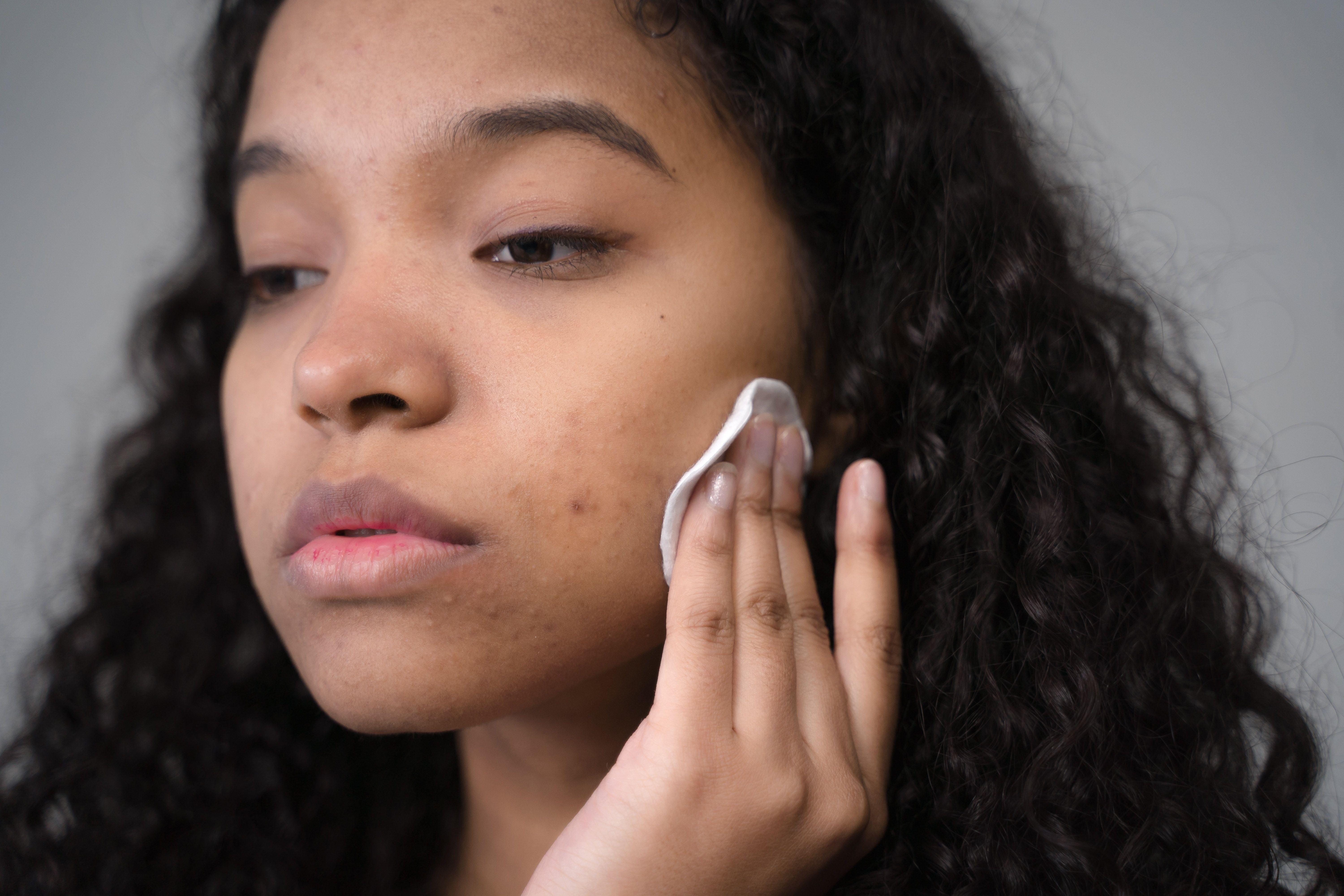 Coming Off the Pill When You Were Put on It for Acne